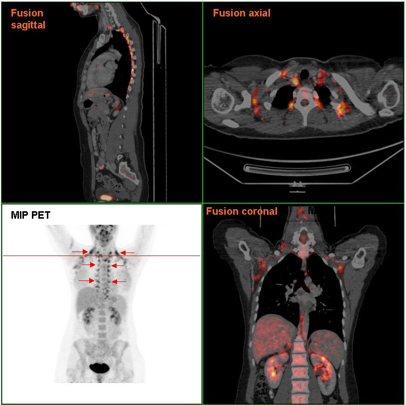 Brown adipose tissue in a woman shown in a PET/CT exam